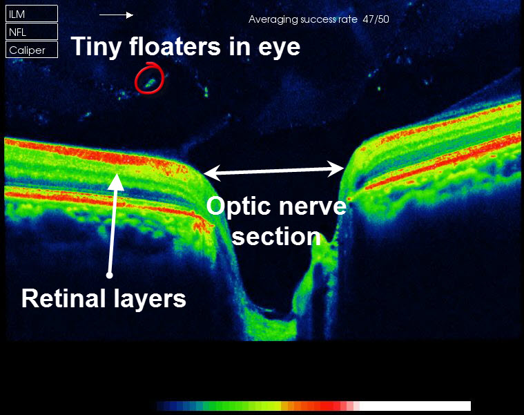 Headache Due To Optic Nerve